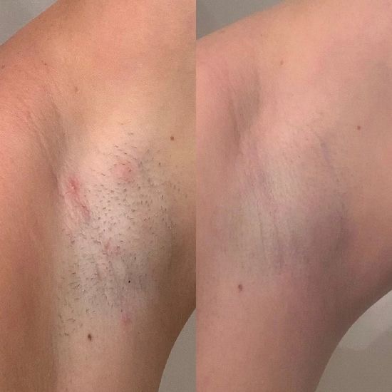 Laser hair removal underarms result