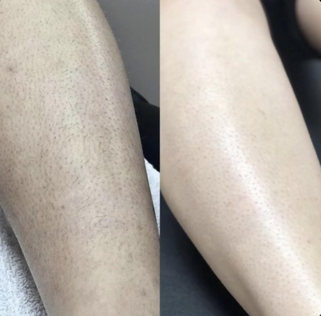 Laser hair removal legs result