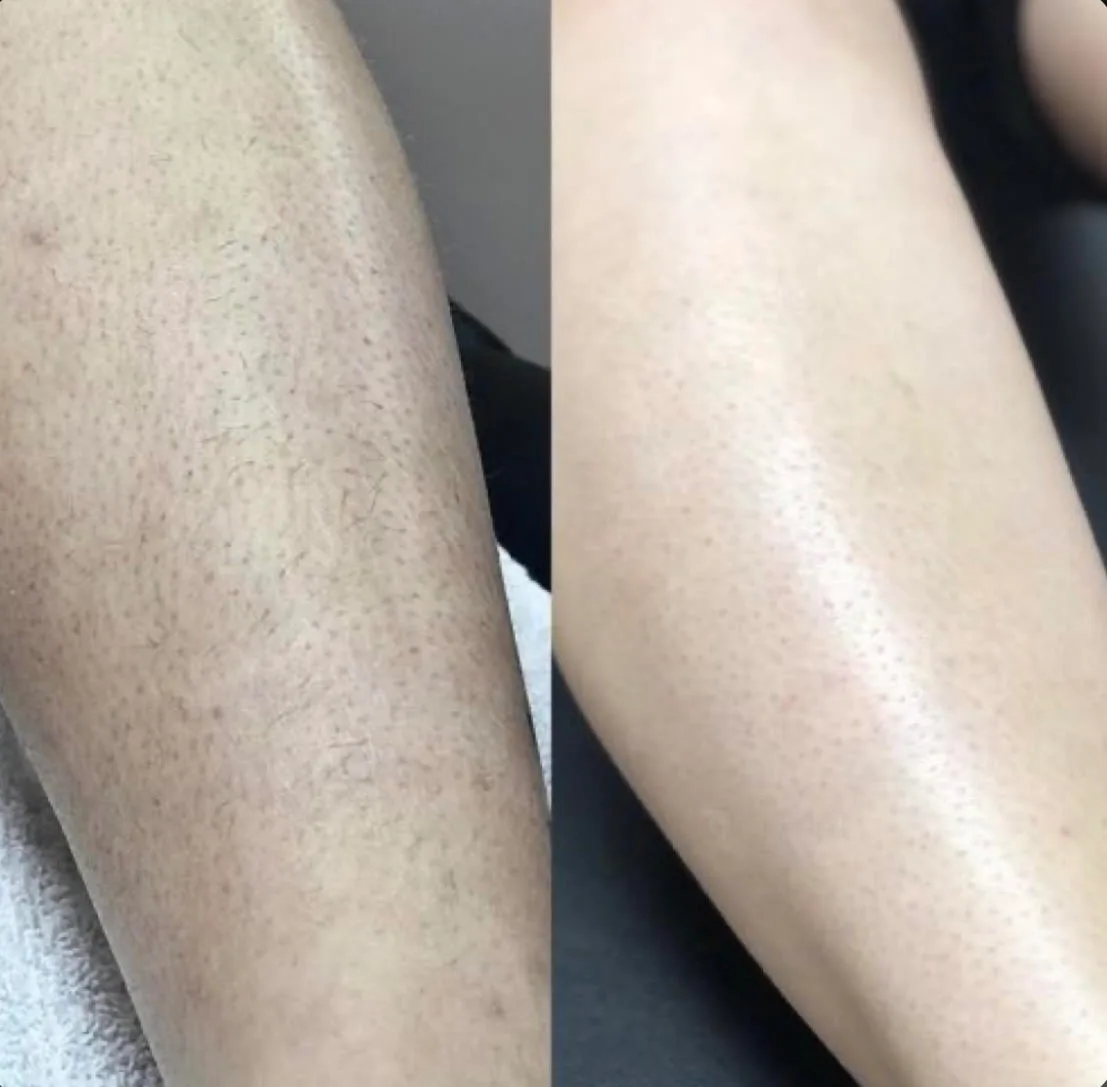 Laser hair removal legs result