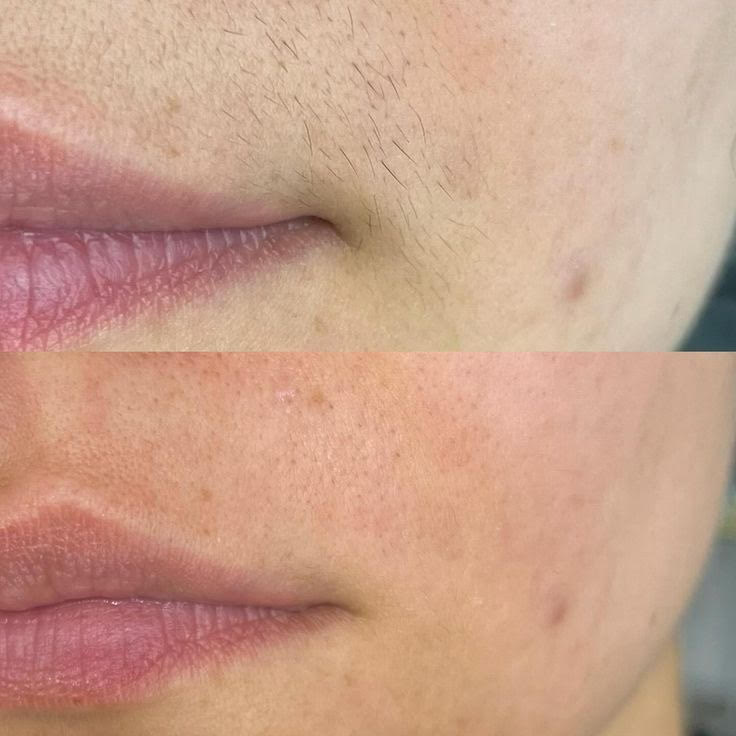 Laser hair removal lip result