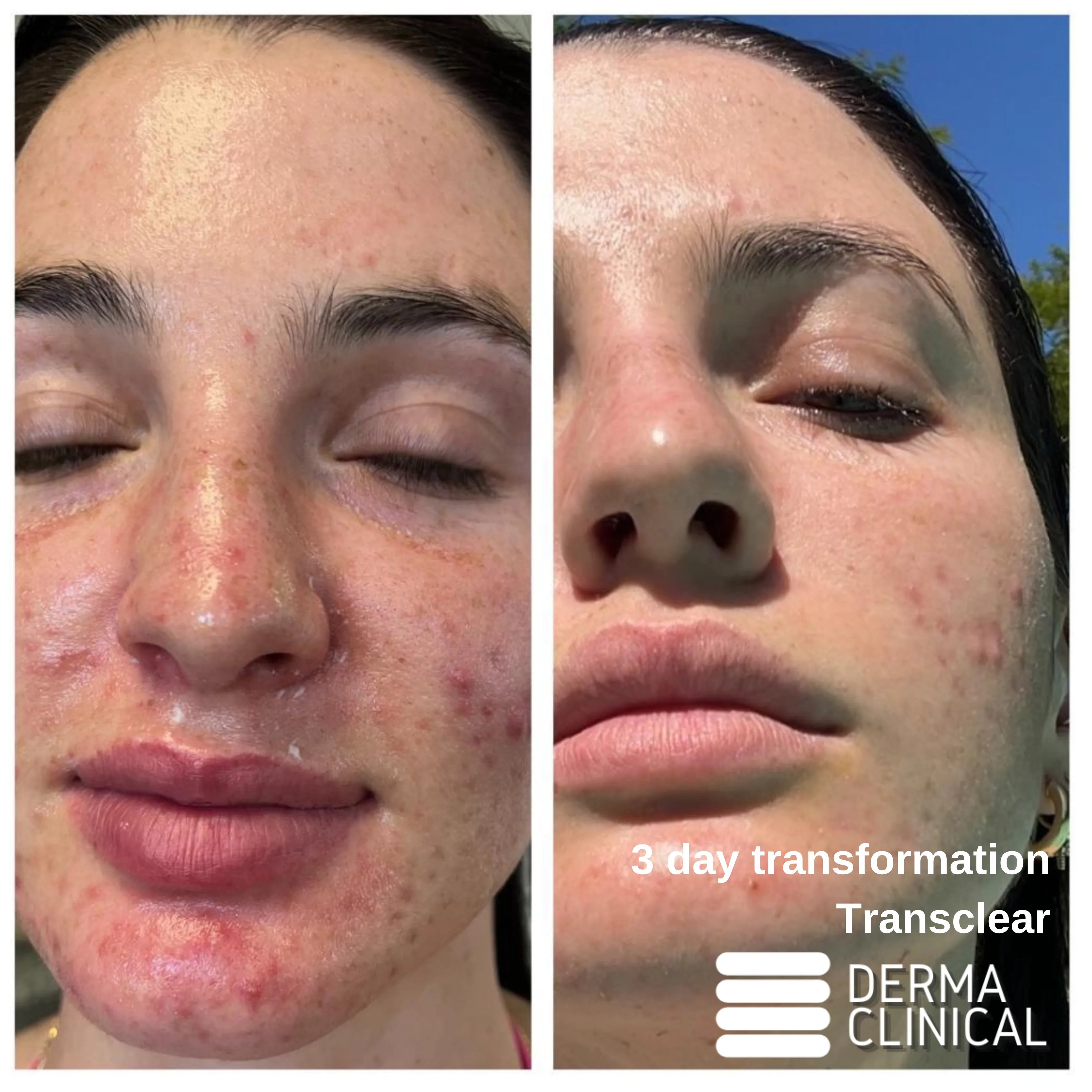 Trans Clear Peel 3-day before and after results