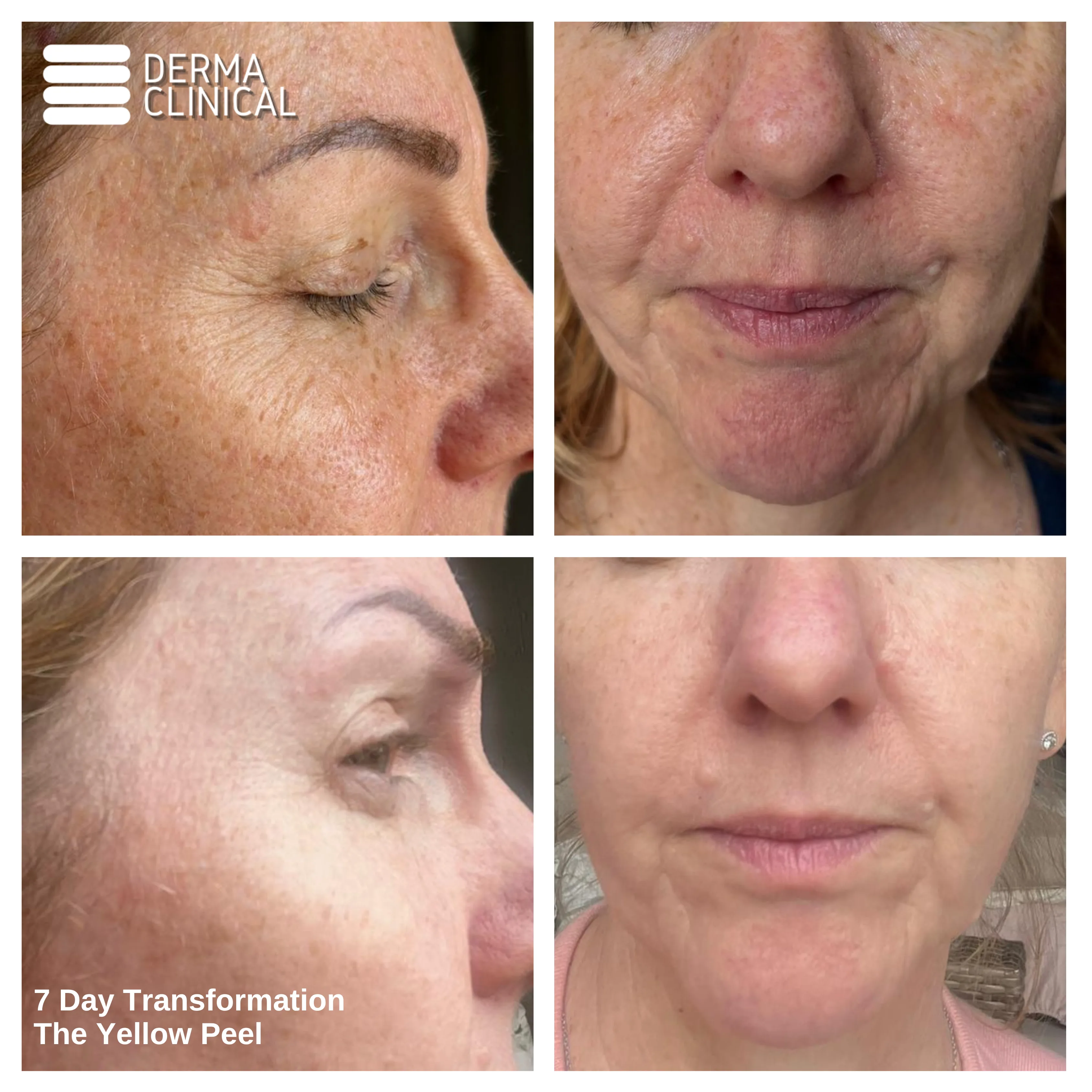 Yellow Peel before and after results